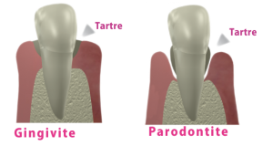 gingivite-paro