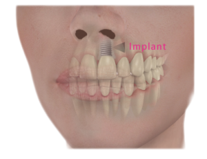 implant-face