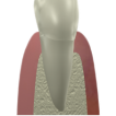 Gum deseases and treatments-thumbnail