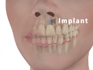 implant-face